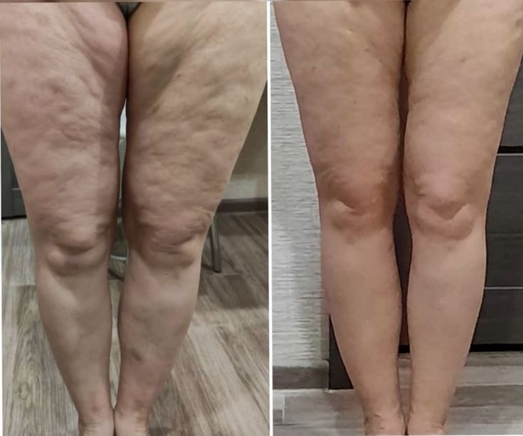 Before and after